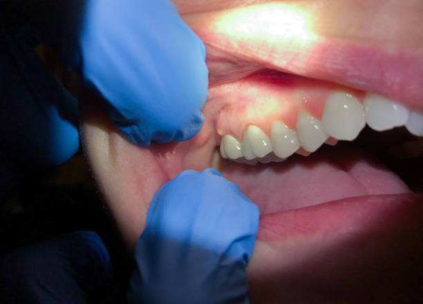Best Emergency Dental Care for Broken or Chipped Teeth in Cottonwood, MN